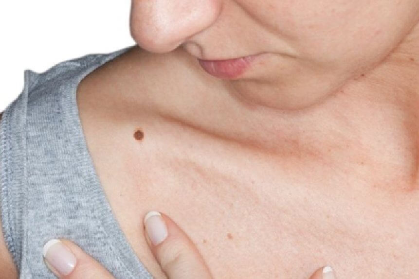 mole removal treatment in delhi