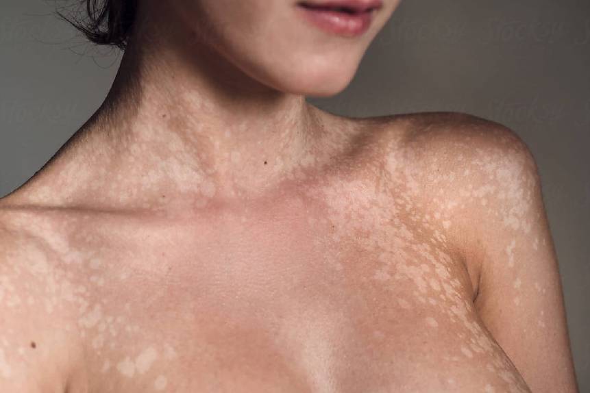 Tinea Versicolor Treatment in Delhi