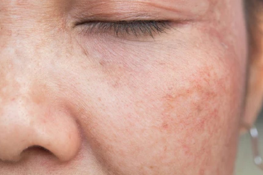 Best Skin Pigmentation Treatment Clinic in Delhi