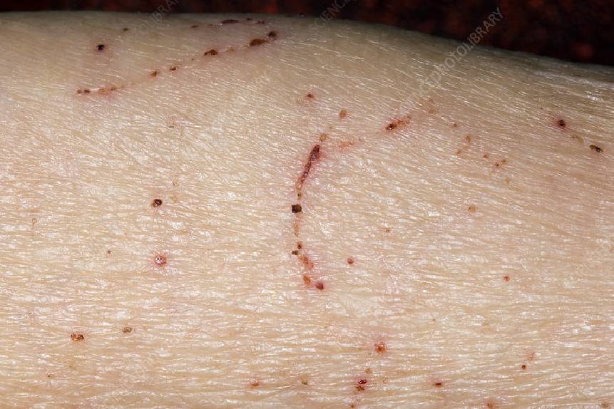 Best Scabies Doctor in Delhi