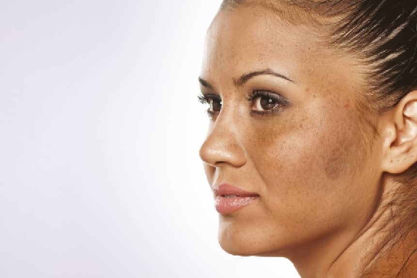 melasma treatment in delhi