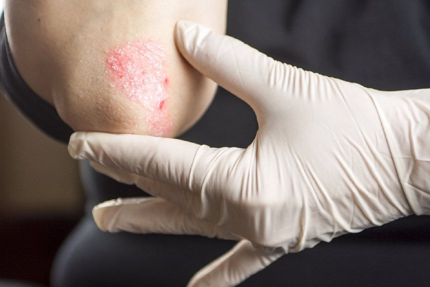 best psoriasis doctor in delhi