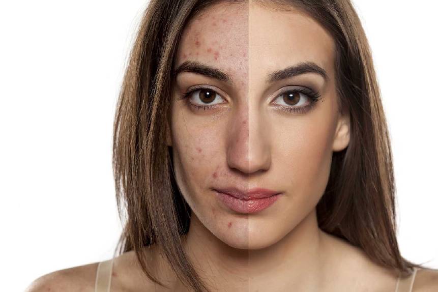 acne scars treatment in delhi