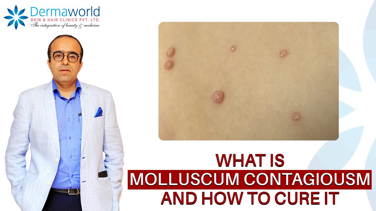 What is Molluscum Contagiosum | Cure for Molluscum Contagiosum