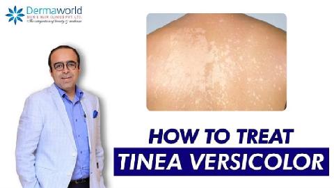 Tinea Versicolor