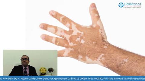 Best White Patches/Vitiligo Treatment in Delhi