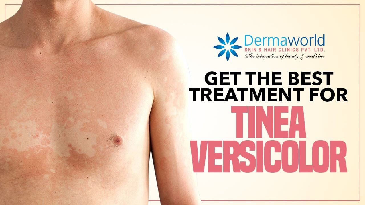 Get The Best Treatment for Tinea Versicolor
