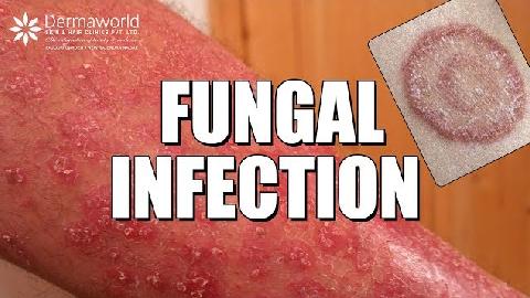 Fungal Infections