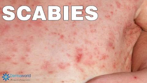 Scabies