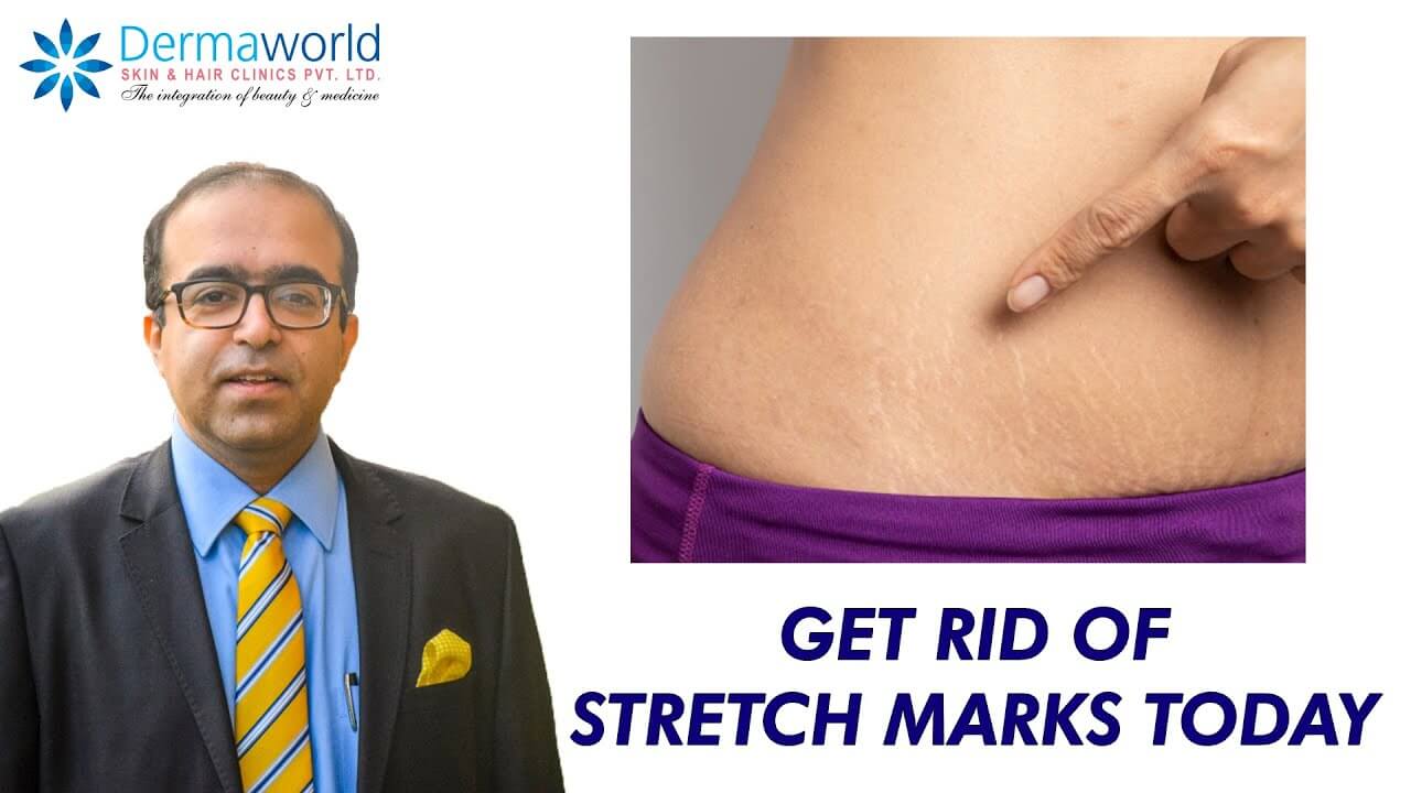 GET RID OF STRETCH MARKS