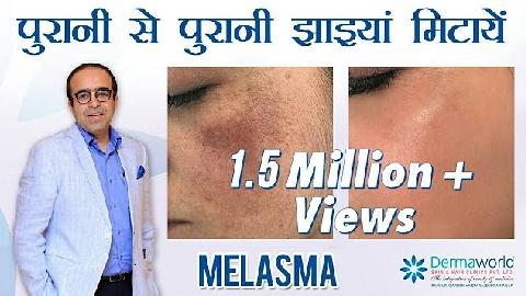 Melasma