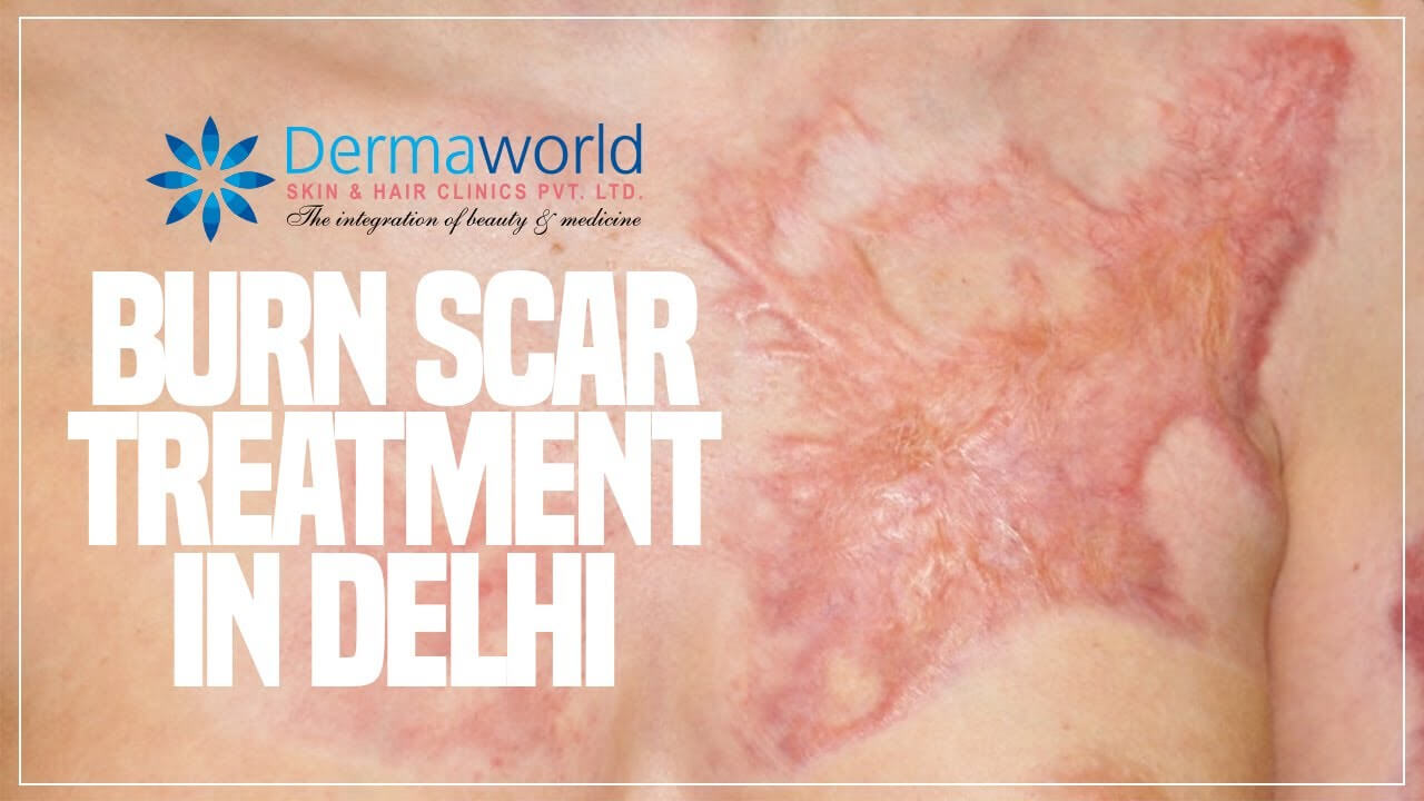 Burn Scar Treatment in Delhi