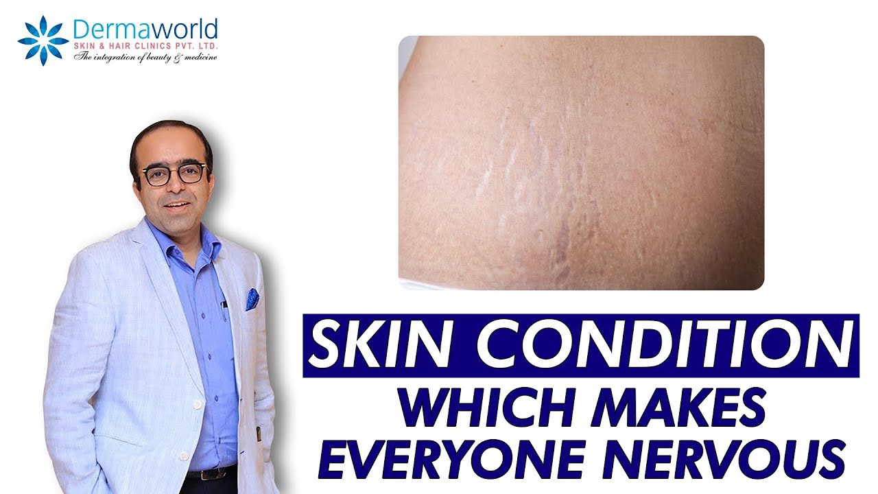 Skin Condition Which Makes Everyone Nervous