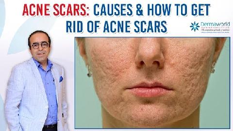 Acne Scars