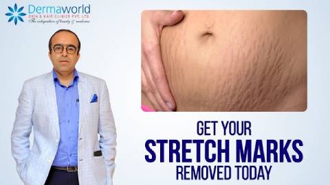 Get Your Stretch Marks Removed | Dr. Rohit Batra