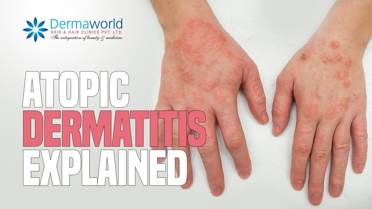Atopic Dermatitis Explained