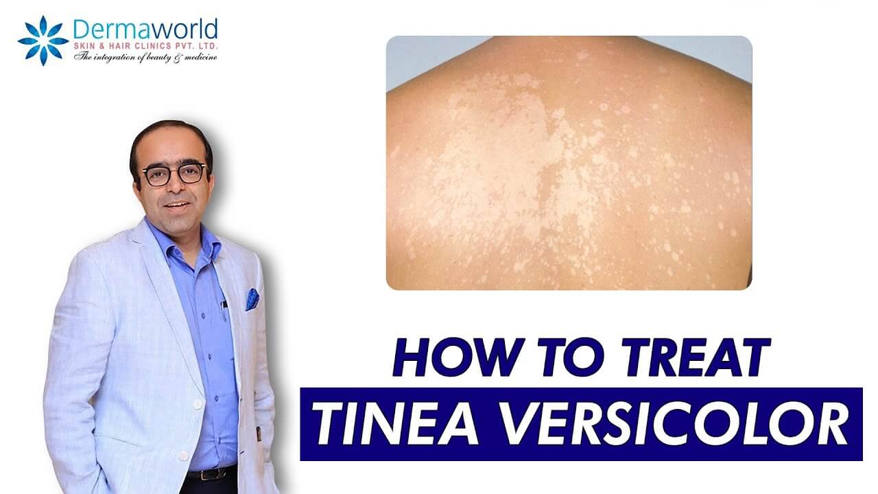 Tinea versicolor | Dr. Rohit Batra