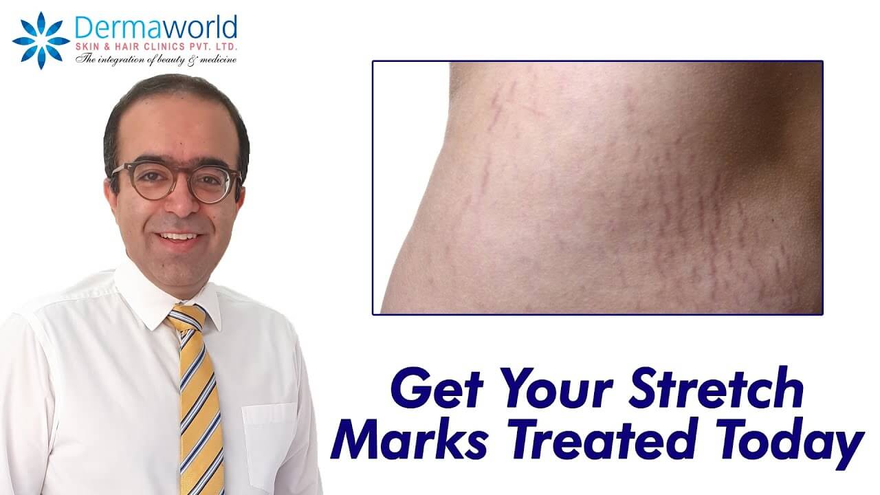 Stretch mark treatment