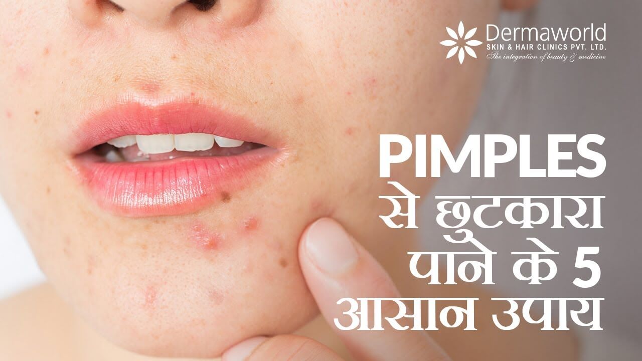 5 Tips to Prevent Pimples