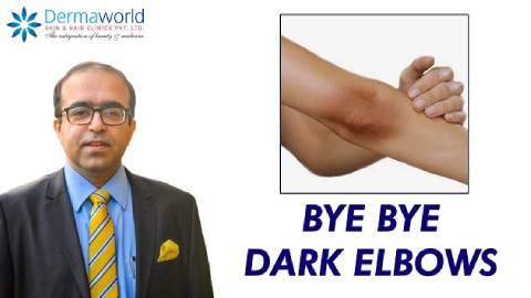 Bye Bye Dark Elbows | Dr. Rohit Batra