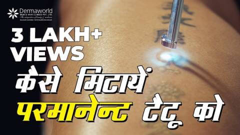 Laser Tattoo Removal in Delhi