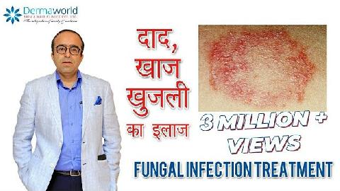 Fungal Infections