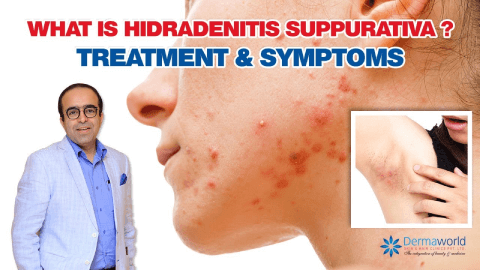 hidradenitis suppurativa treatment