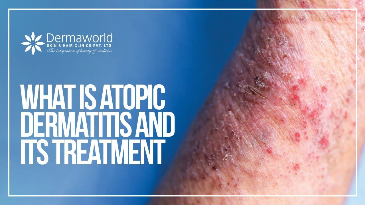 What is atopic dermatitis and its Treatment 