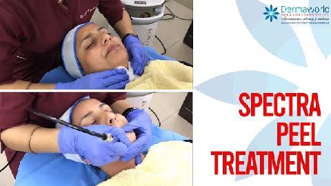 Carbon Laser Peel