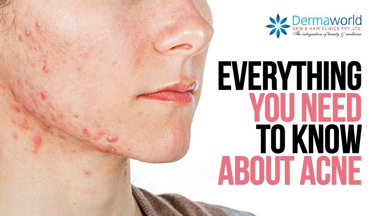The Science of Acne | All you need to know about acne