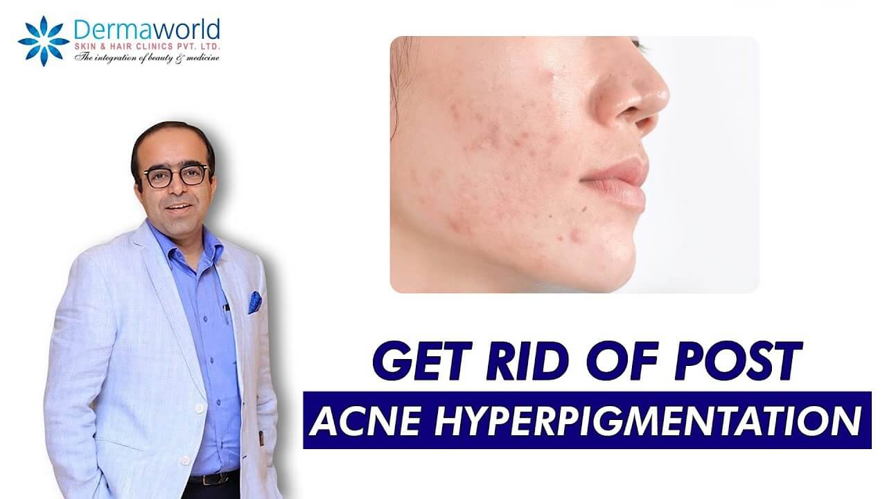 How to get Rid of Acne Hyperpigmentation